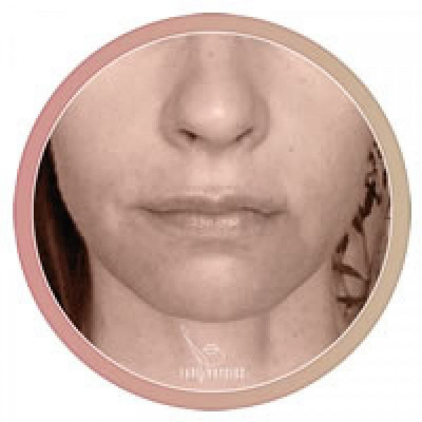 Facephysics intensive Course: Upper Lip Lift + 6 month